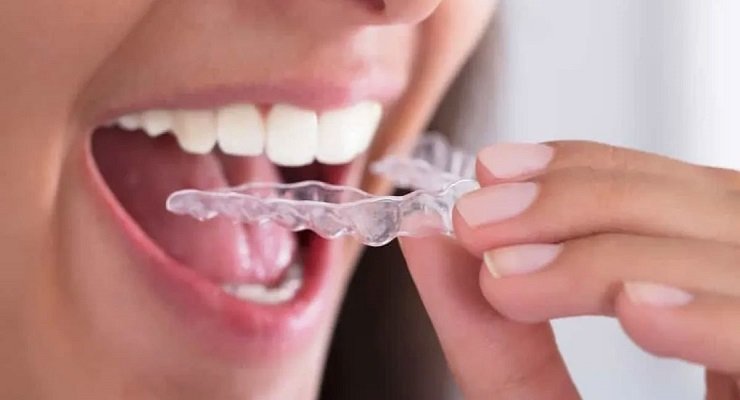 Orthodontic treatment In Udaipur